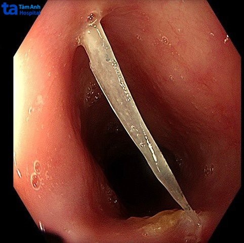 Liên tiếp nhiều ca hóc dị vật nguy hiểm -0