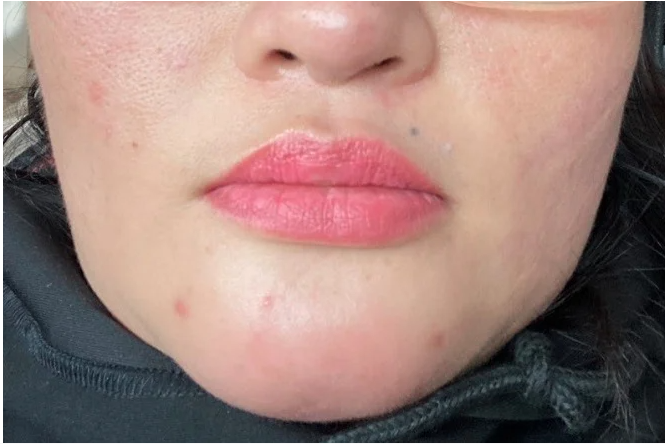 Làm đẹp tại cơ sở không uy tín, nữ bệnh nhân nhiễm trùng sau khi tiêm Filler -0