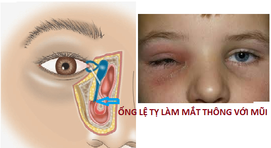 Tại sao viêm mũi xoang lại ảnh hưởng tới mắt -0