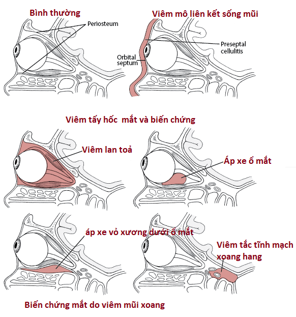 Tại sao viêm mũi xoang lại ảnh hưởng tới mắt -0