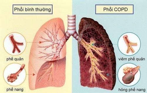 Những dấu hiệu nhận biết sớm giúp điều trị bệnh phổi tắc nghẽn mạn tính -0