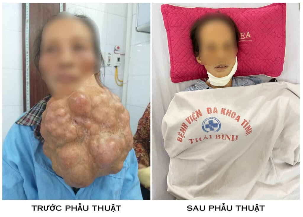 Bóc tách khối u 