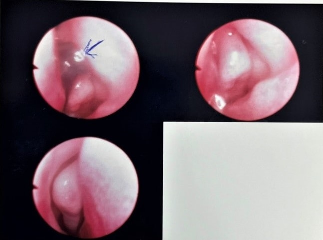 Tắm suối, bé gái cấp cứu do bị vắt chui vào mũi -0