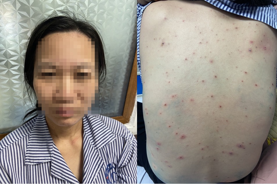 Tiếp xúc với 2 học sinh mắc bệnh thủy đậu, nữ giáo viên biến chứng nặng -0
