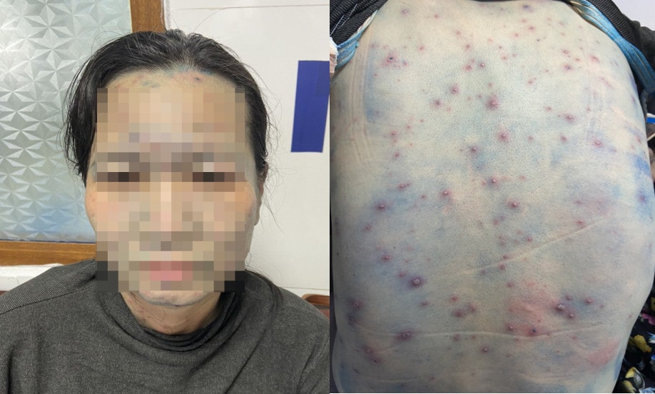 Tiếp xúc với 2 học sinh mắc bệnh thủy đậu, nữ giáo viên biến chứng nặng -0