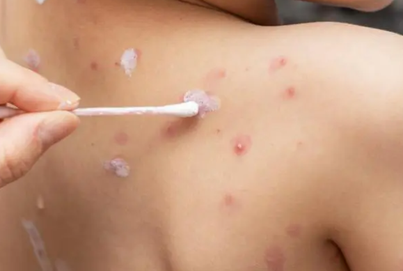 Người dân cần làm gì để phòng tránh bệnh thủy đậu? -0