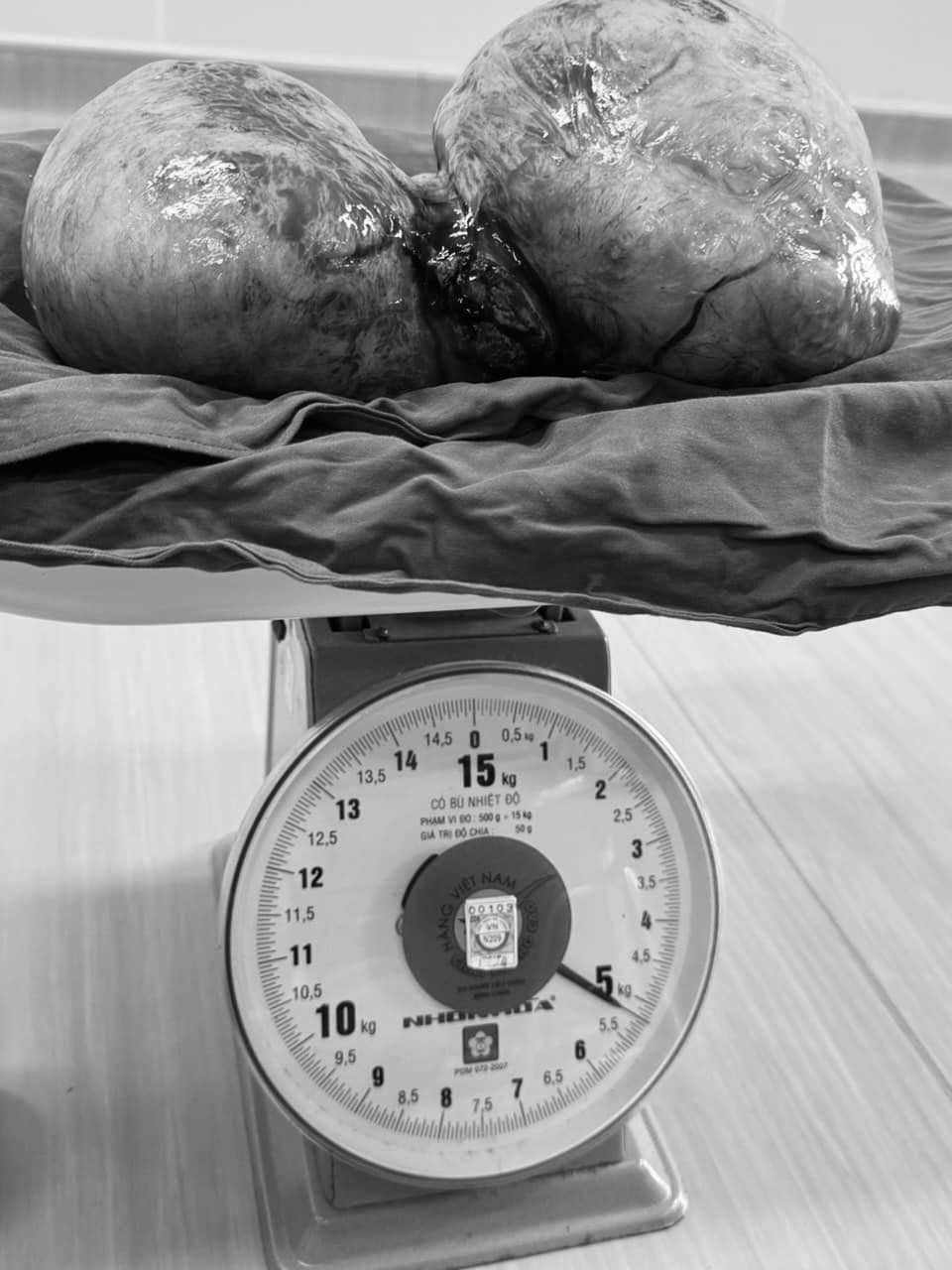 Khối u xơ tử cung nặng 5,3kg chiếm toàn bộ ổ bụng người phụ nữ -0
