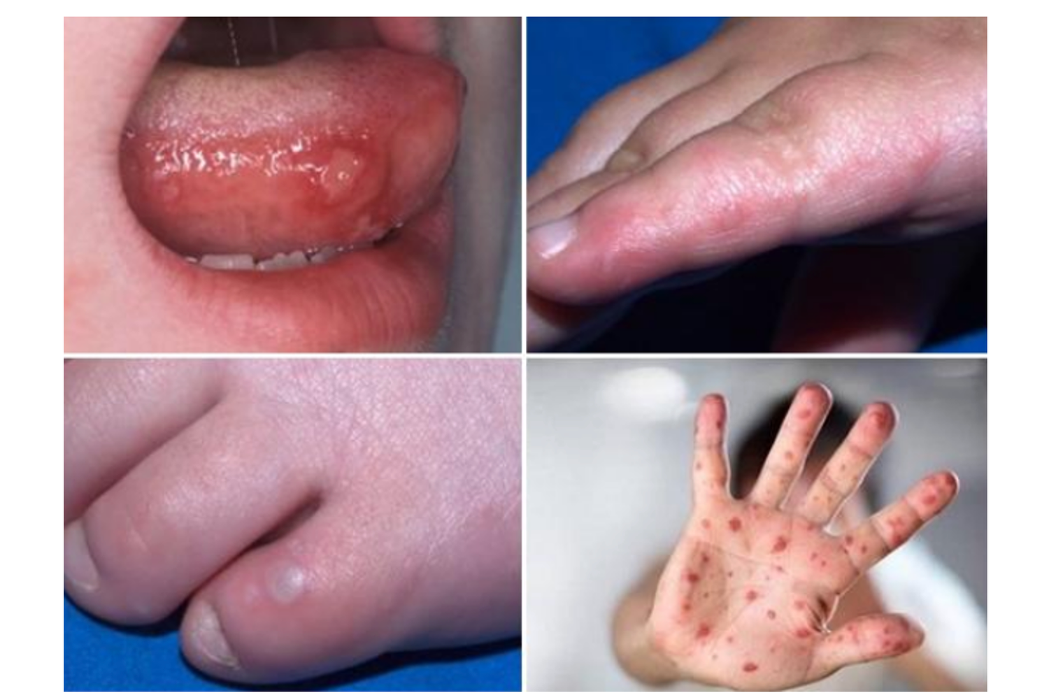 Những bệnh thường gặp ở trẻ nhỏ trong mùa nắng nóng -0