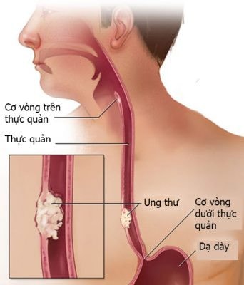 bien-phap-phong-chong-benh-ung-thu-thuc-quan-342x400.jpg -0