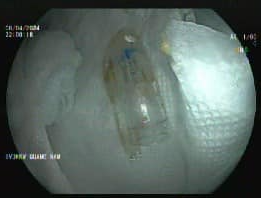 Bé gái vô tình nuốt nắp bút dài gần 4cm khi đang ngồi học -0