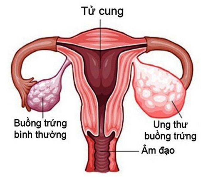 Ung thư buồng trứng nguy hiểm như thế nào? -0
