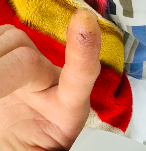 Bị Cu li cắn, người đàn ông ngộ độc nặng -0