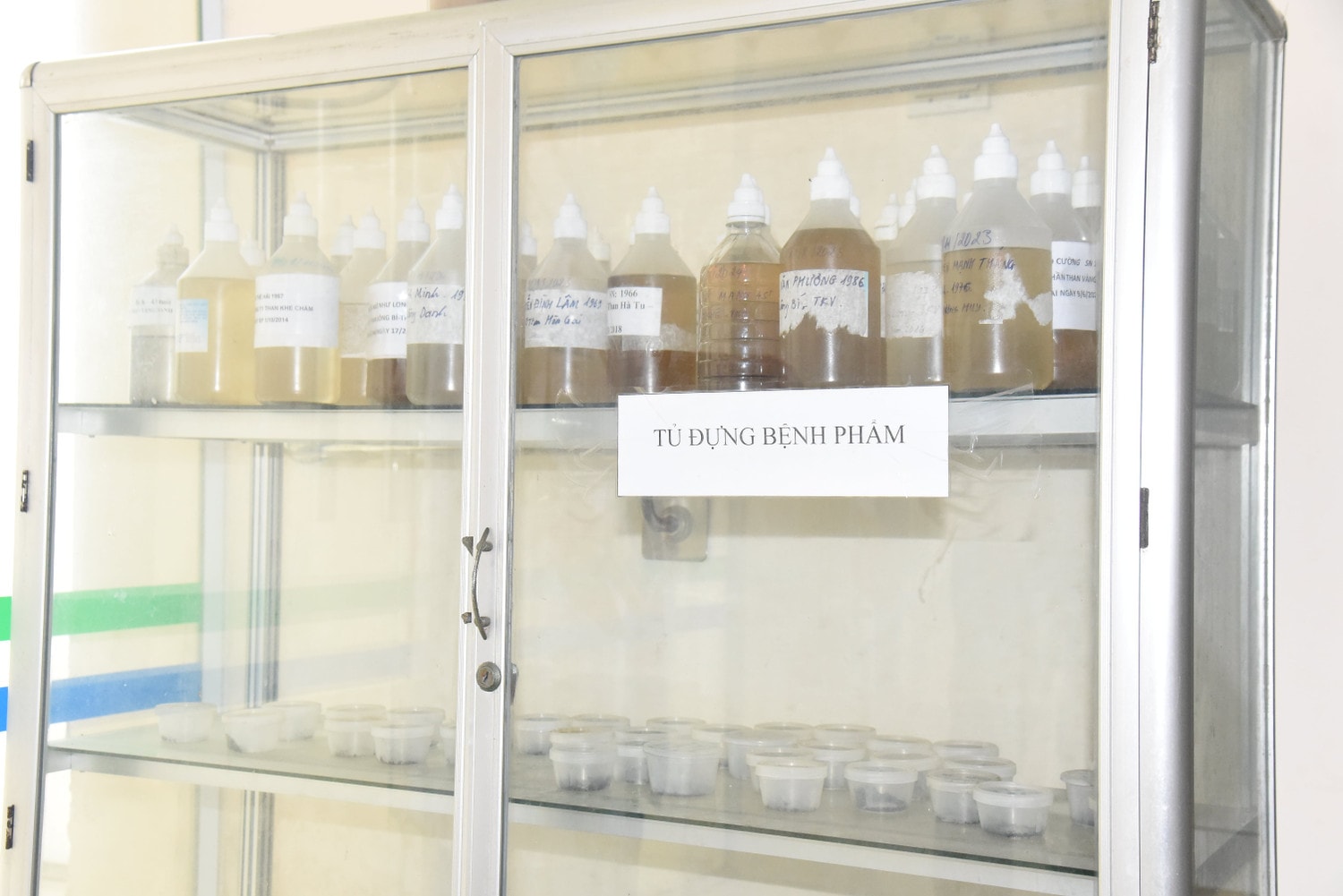Cận cảnh quá trình súc rửa phổi cho công nhân ngành than -1