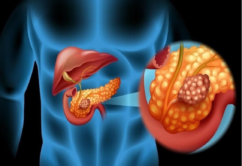 Những dấu hiệu nhận biết giúp điều trị sớm bệnh ung thư tuyến tụy -0