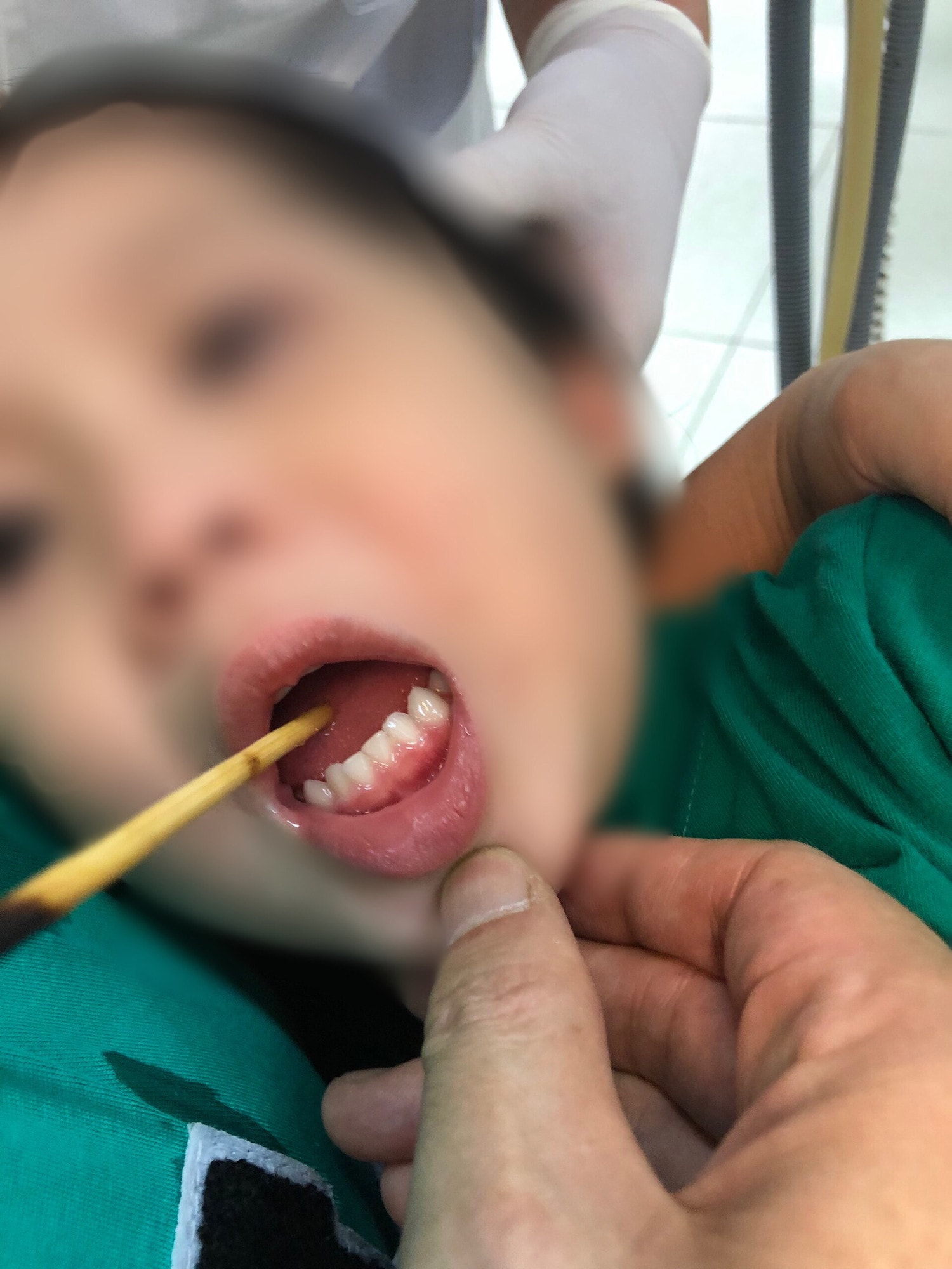 Hy hữu: Dị vật xiên thịt đâm xuyên lưỡi bé trai -0