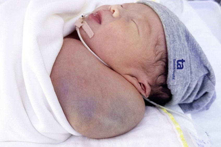 Đại phẫu cứu bé trai có khối u nặng bằng 1/3 trọng lượng cơ thể -0