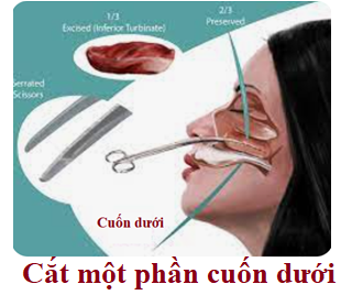 Tái tạo lại chức năng thở của mũi trong hội chứng mũi rỗng bằng tế bào gốc -0