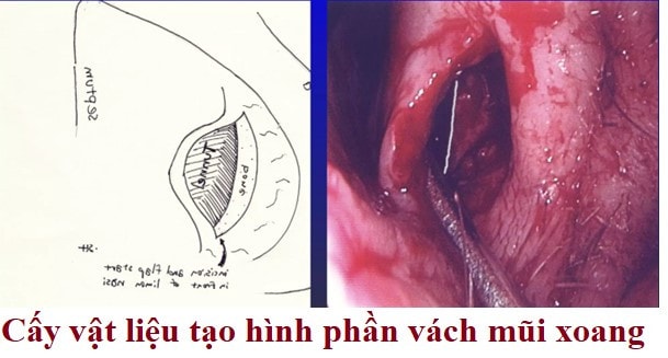 Tái tạo lại chức năng thở của mũi trong hội chứng mũi rỗng bằng tế bào gốc -0