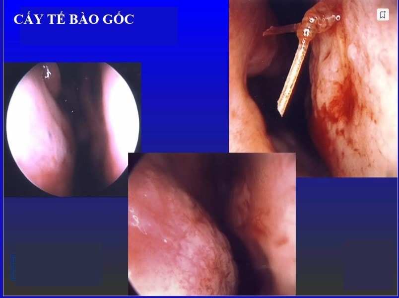 Tái tạo lại chức năng thở của mũi trong hội chứng mũi rỗng bằng tế bào gốc -0