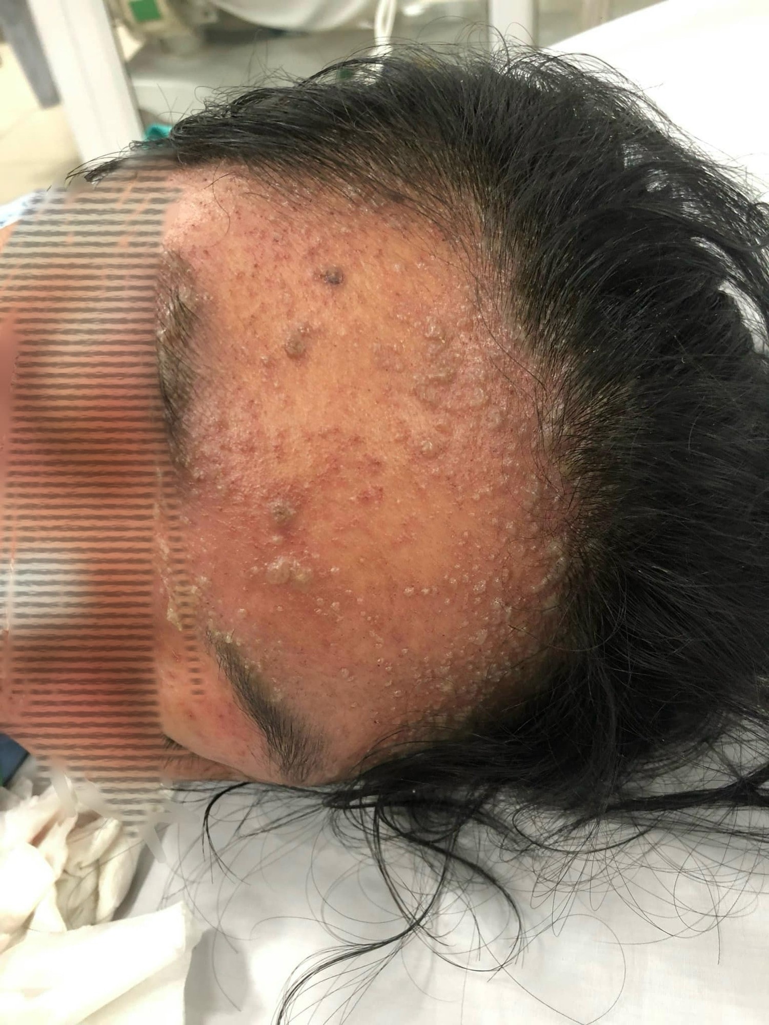 Cô gái 17 tuổi suýt tử vong do mắc thủy đậu nặng -0