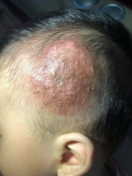 Bé trai 9 tuổi nhiễm nấm tổ ong da đầu do lây từ chó mèo nuôi -0