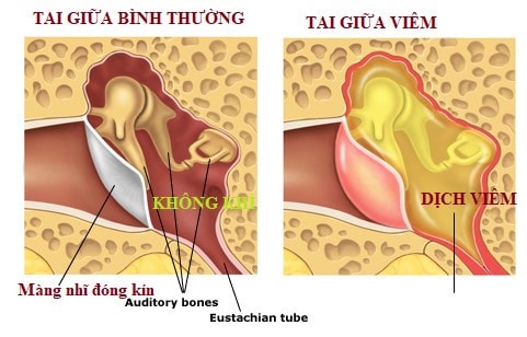Tại sao điều trị viêm tai giữa thường kéo dài nhiều tuần -0
