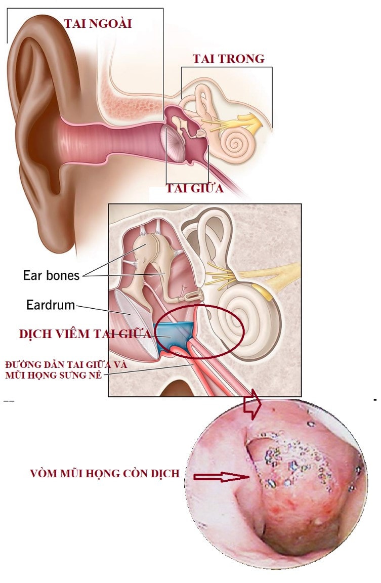 Tại sao điều trị viêm tai giữa thường kéo dài nhiều tuần -0
