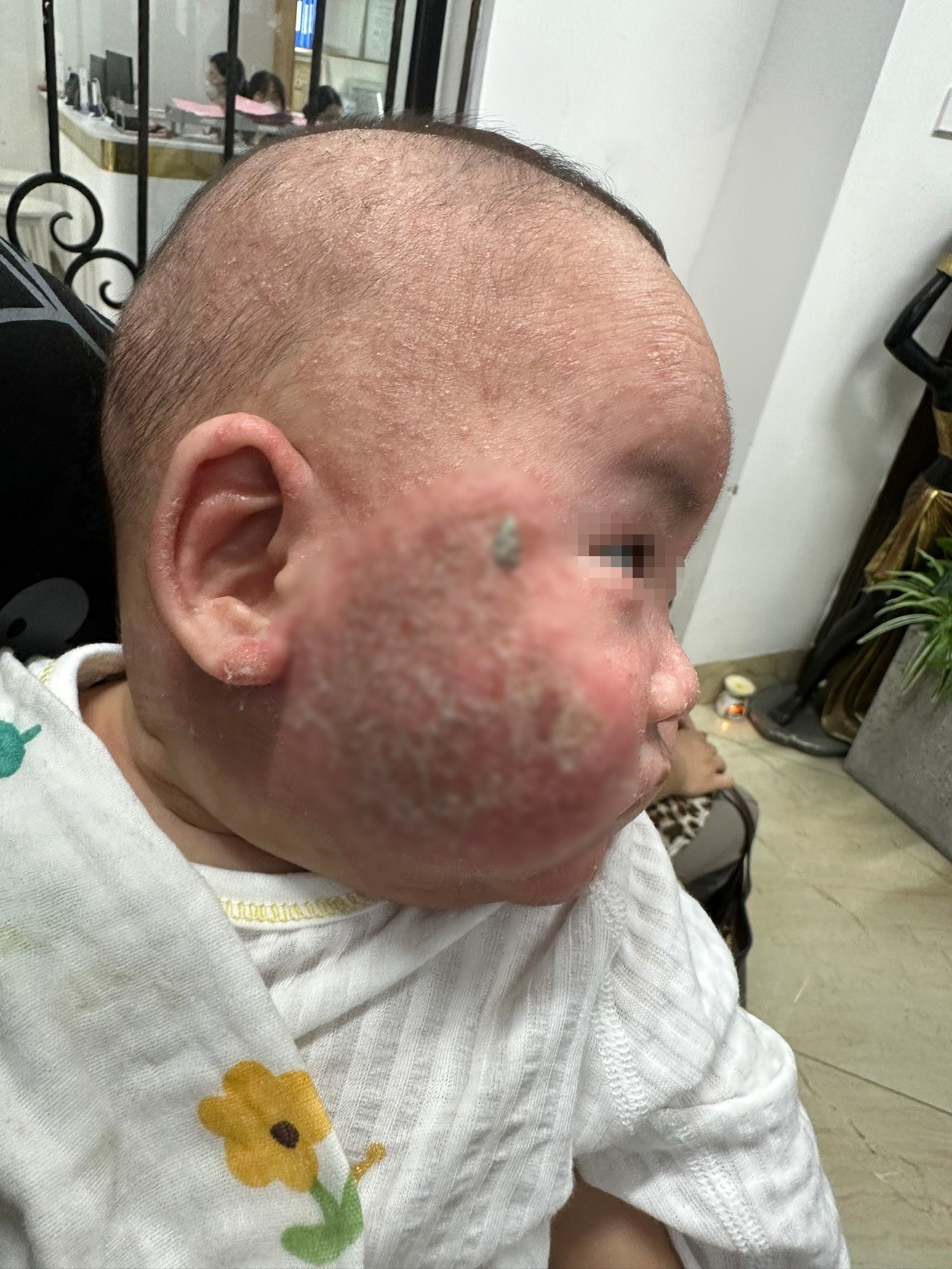 Bé 5 tháng tuổi chảy mủ nặng nề hai bên má do gia đình tự điều trị viêm da cơ địa sai cách -0