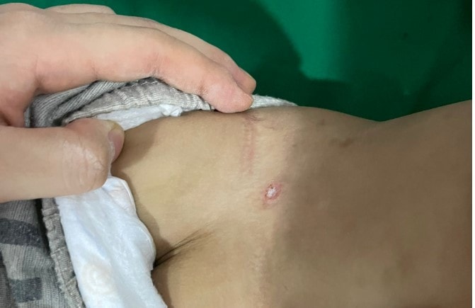 Bác sĩ cảnh báo, nguy hiểm từ vết sốt mò của trẻ nhỏ -0