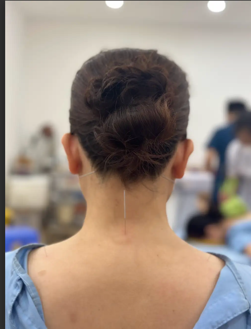Bệnh đau đầu có nên châm cứu, xoa bóp bấm huyệt không? -0