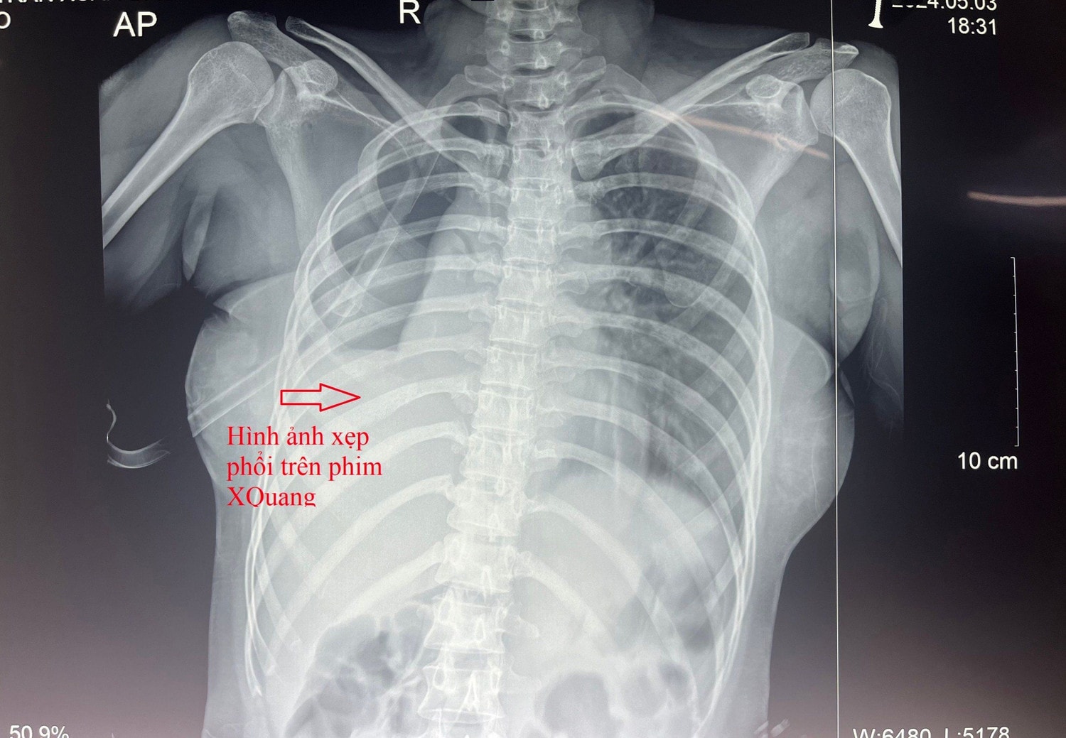 Cứu sống bệnh nhân đứt rời phế quản -0
