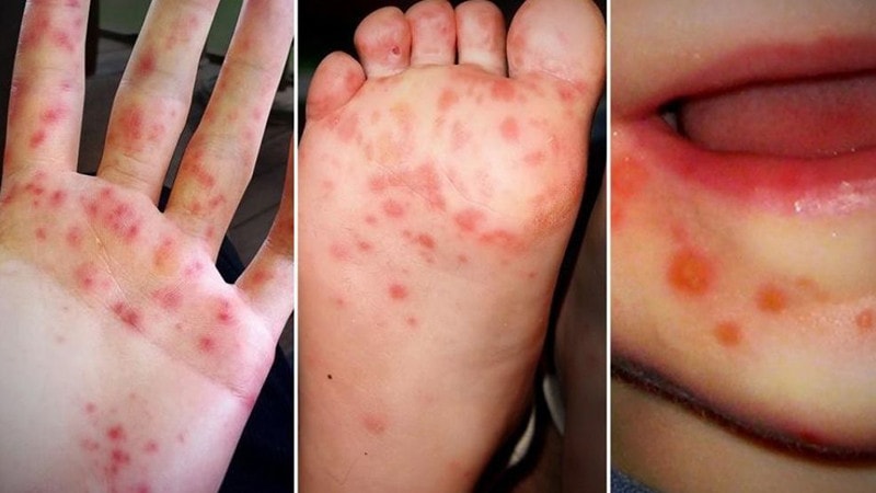 TP. Hồ Chí Minh: Số ca mắc bệnh tay chân miệng có xu hướng gia tăng