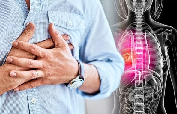 11 dấu hiệu ung thư phổi cần lưu tâm để chủ động tầm soát -0