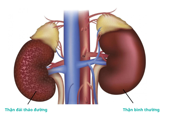 Cần phát hiện sớm biến chứng thận do đái tháo đường -0