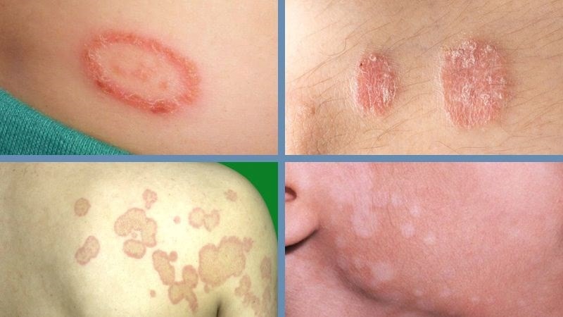 5 loại bệnh nấm da thường gặp -0