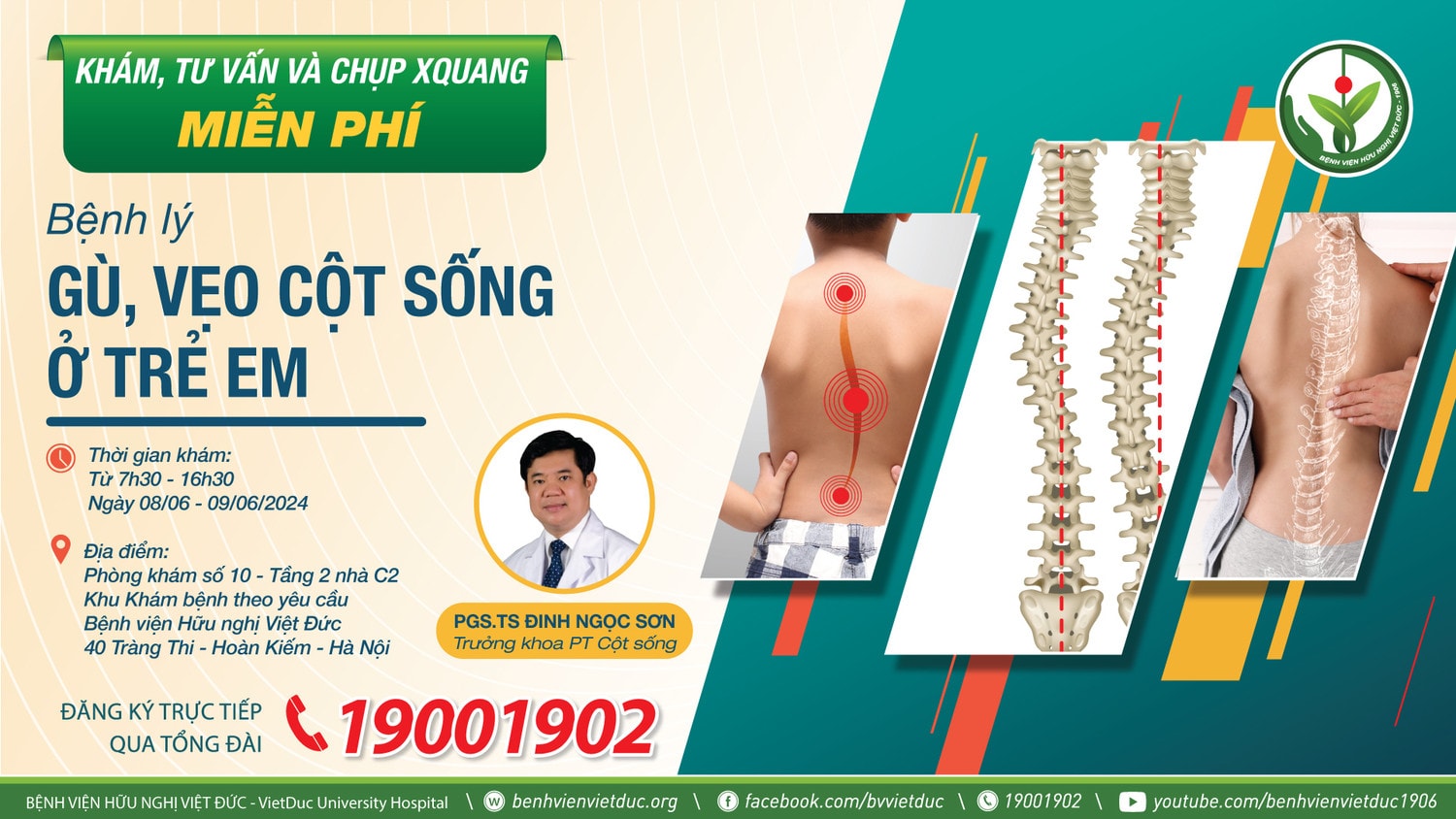 Bệnh viện Hữu nghị Việt Đức sẽ tổ chức khám sàng lọc miễn phí và phẫu thuật điều trị gù vẹo cột sống ở trẻ em -0