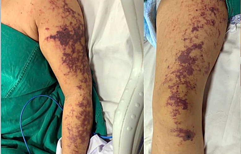 Yên Bái: Mắc liên cầu lợn vì… nem chua -0