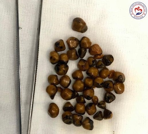 Người phụ nữ có túi mật chứa hơn 40 viên sỏi -0