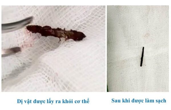 Người đàn ông bất ngờ phát hiện chiếc đinh cắm sâu vào vùng cổ sau 15 năm -0