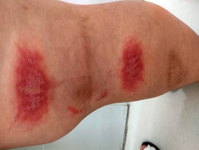 Thành phố Hồ Chí Mình: Nhiều trường hợp viêm da do tiếp xúc kiến ba khoang -0