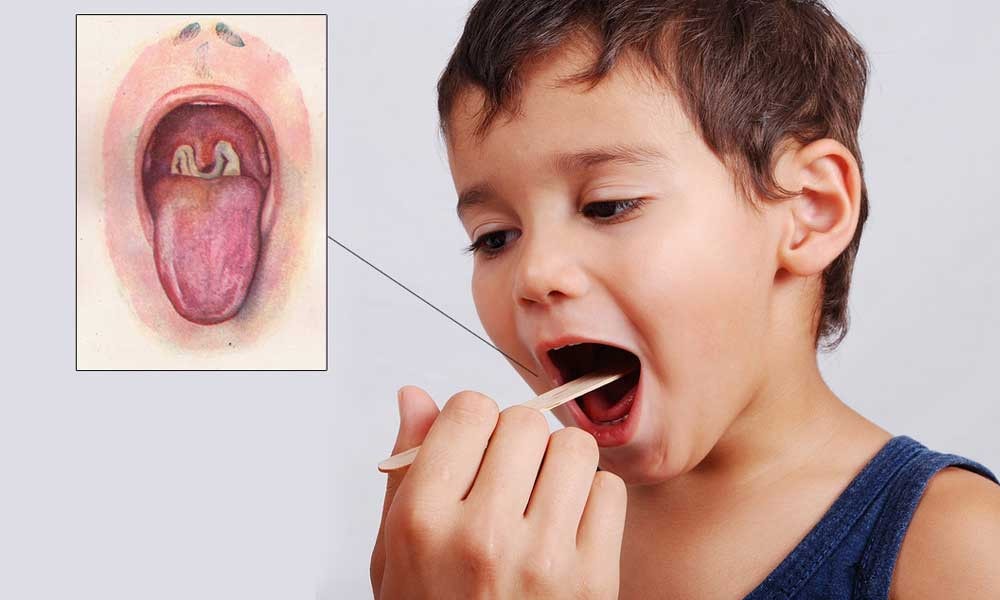 Lưu ý về các ca bệnh nghi bạch hầu cần được hội chẩn tuyến trên -0