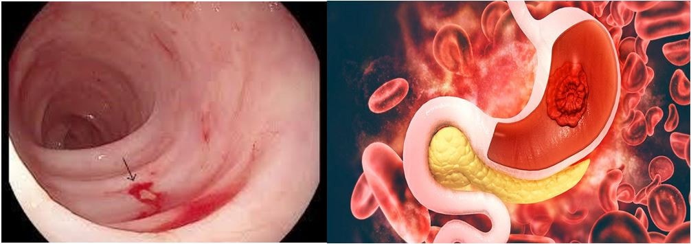 Báo động gia tăng tình trạng xuất huyết tiêu hóa ở lứa tuổi học sinh -0