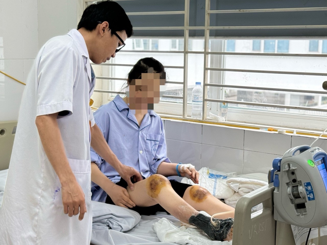 Cho ong đốt chữa viêm khớp, người phụ nữ hoại tử nặng nề cẳng chân -0