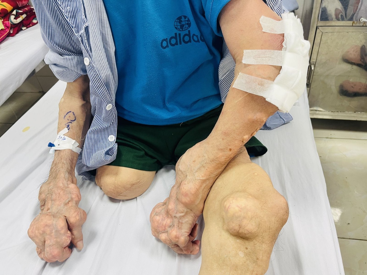 Bác sĩ cảnh báo, biến chứng nhiễm trùng hạt tophi cực nguy hiểm do bệnh gout lâu năm -0