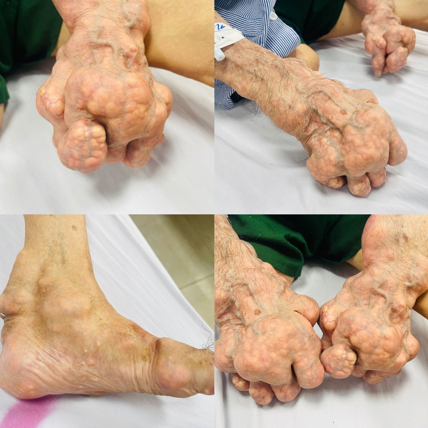 Bác sĩ cảnh báo, biến chứng nhiễm trùng hạt tophi cực nguy hiểm do bệnh gout lâu năm -0