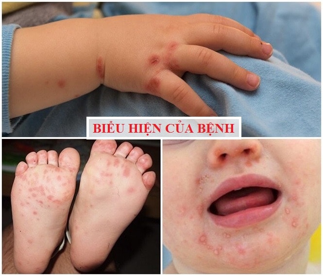 Dấu hiệu phát hiện sớm và cách phòng bệnh tay chân miệng -0