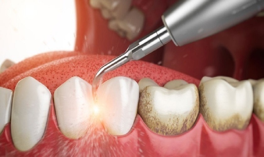 Tại sao nên lấy cao răng định kỳ? -0