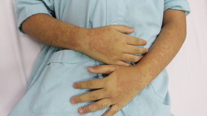 Bác sĩ cảnh báo, dị ứng hải sản nguy hiểm không nên chủ quan -0