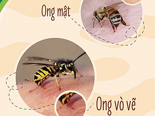 Liên tiếp các vụ trẻ nhập viện do ong vò vẽ đốt -0