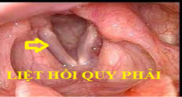 Đối phó ra sao với khàn tiếng? -0